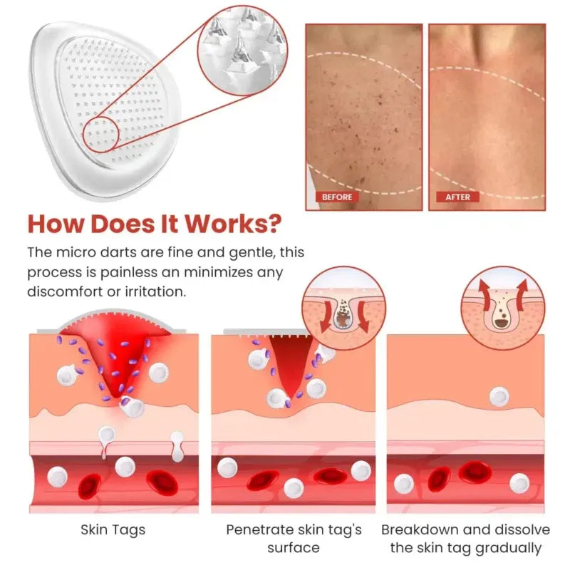 Derma Smooth Skin Tag Removal Patch🔥
