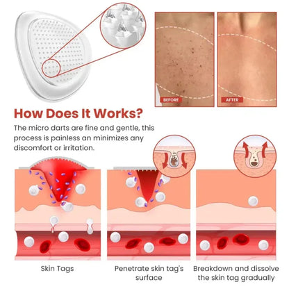Derma Smooth Skin Tag Removal Patch🔥
