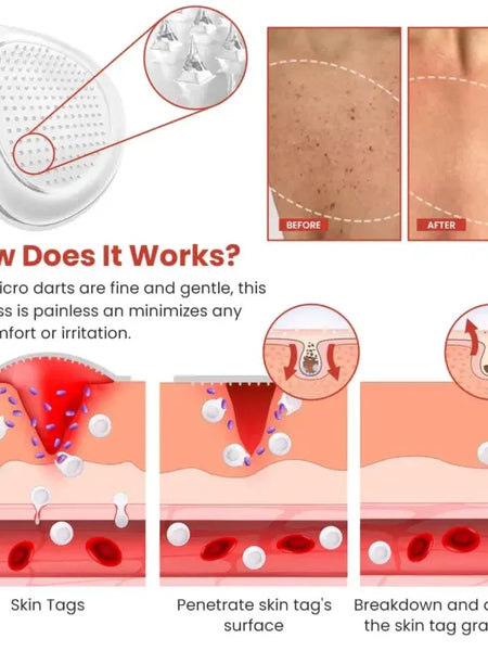 Derma Smooth Skin Tag Removal Patch🔥